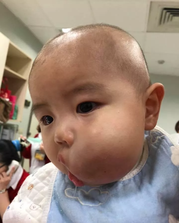 台湾医疗曹小弟弟左侧嘴角有一个小肿块