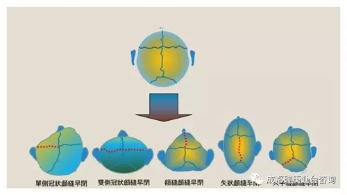 台湾长庚医院治颅缝早闭症