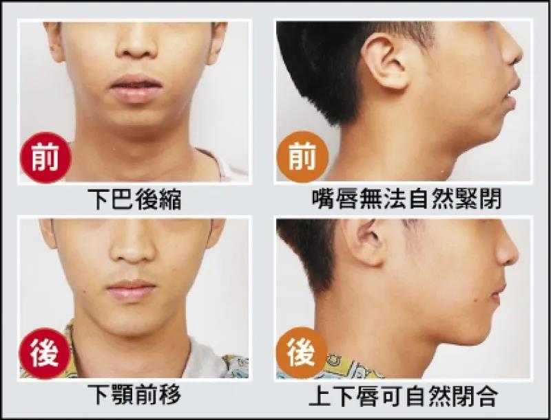 正颚手术治好打鼾