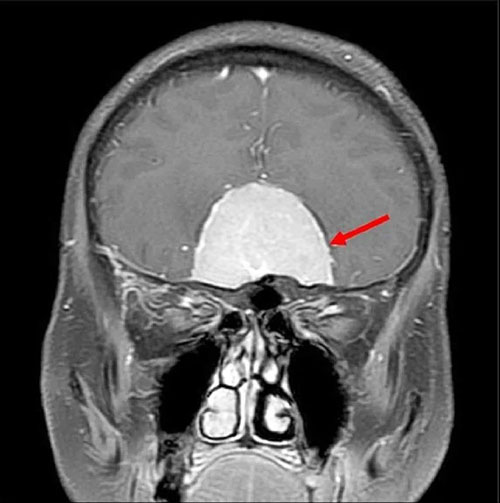 微创钥匙孔开颅术,开脑免剃光头 微创钥匙孔开颅术,开脑免剃光头