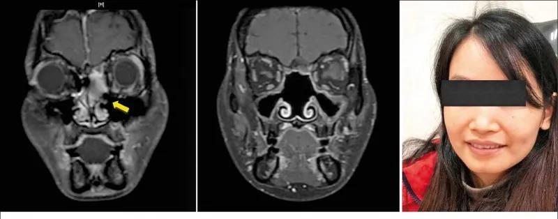 罹患了罕见的嗅神经母细胞癌且侵犯脑膜