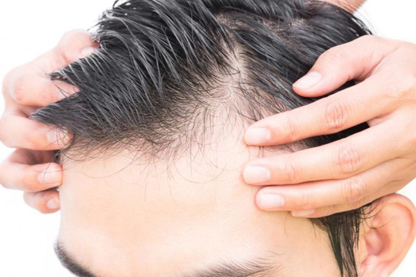 發現頭發日漸稀疏該怎么辦？搶救毛囊常見的3種治療法