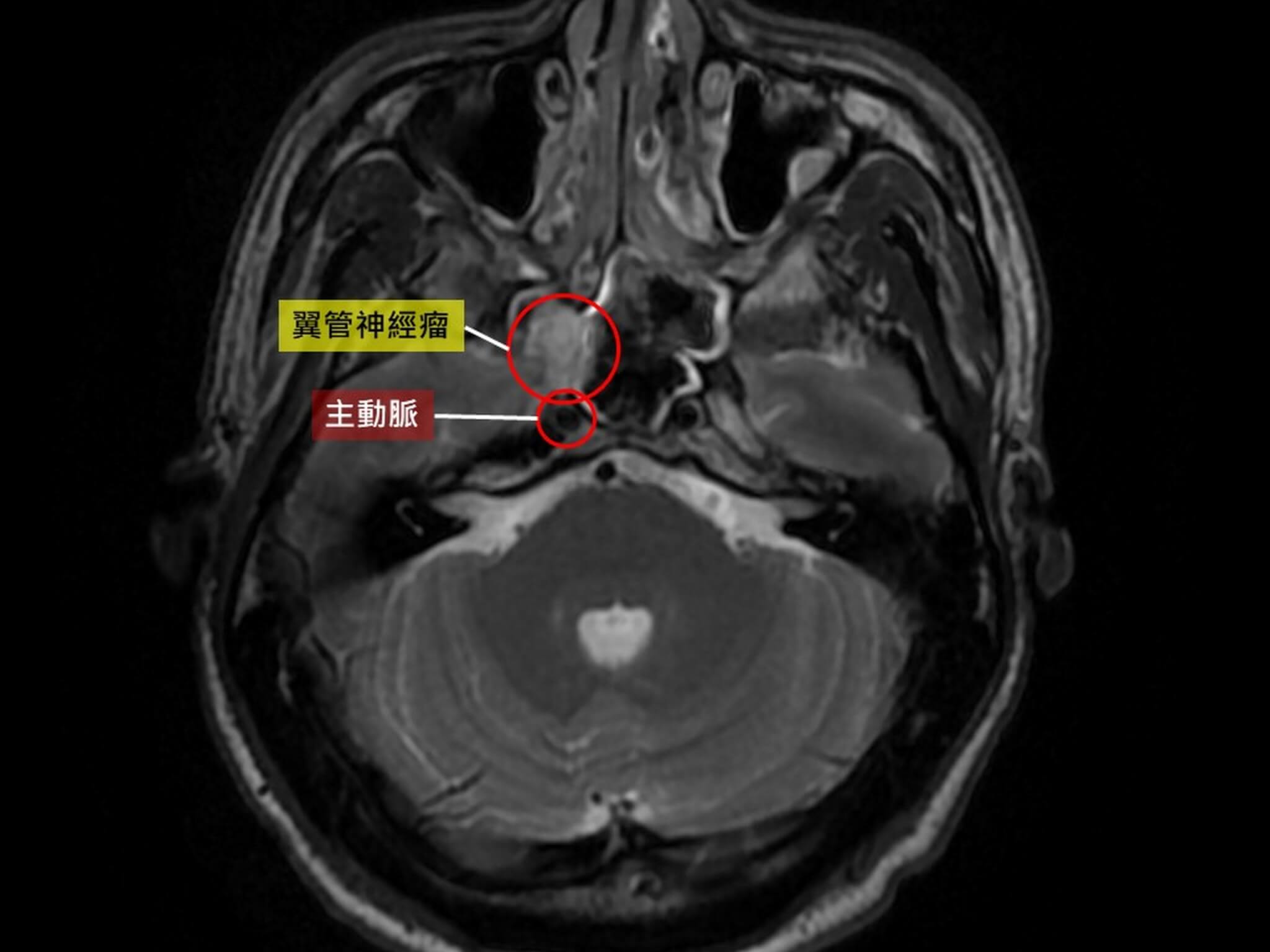 全台湾首例！鼻水狂流原来是全球不到20例的罕见神经瘤