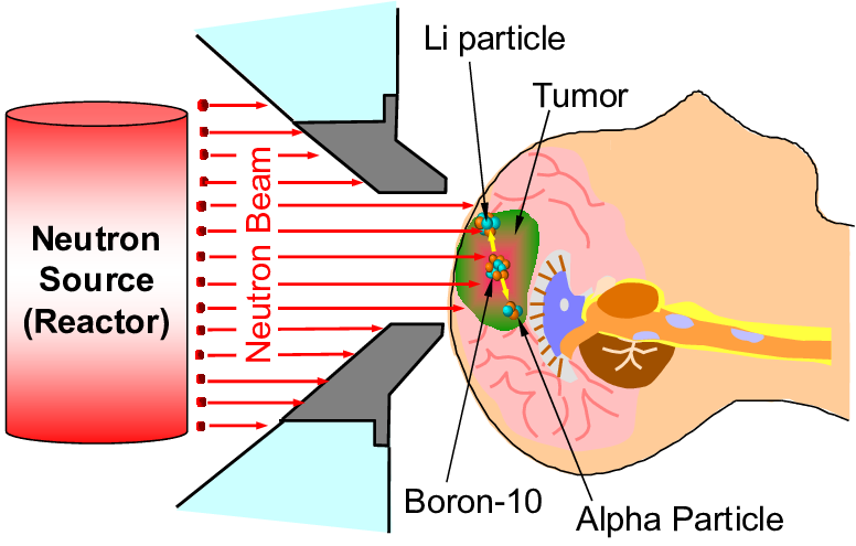 BNCT案例 | 恶性神经胶质瘤的硼中子俘获治疗