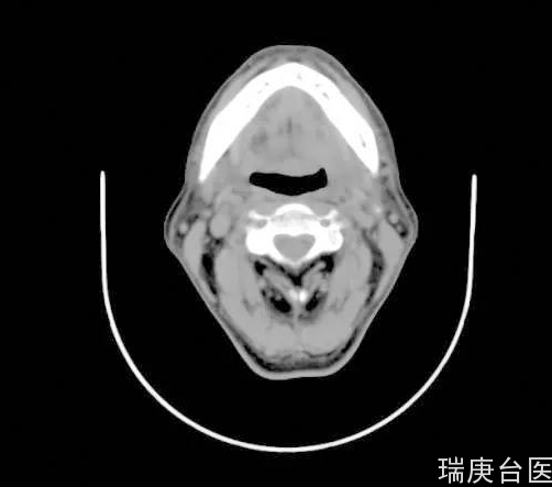臺灣質子治療中心 | 質子治舌根癌完全治愈存活八年