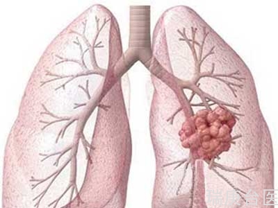 案例 | 肺癌質子治療 生命新希望