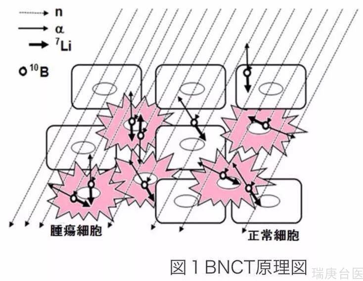 BNCT | 新型肿瘤辅助治疗方法之一