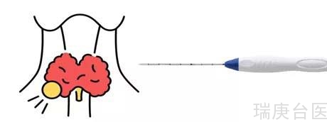 【医学新知】甲状腺结节无痕治疗：射频消融