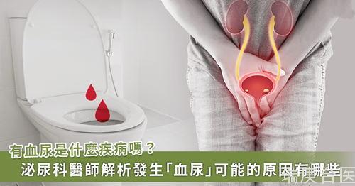 出現「血尿」可能是哪些疾??？不會痛的血尿更要注意