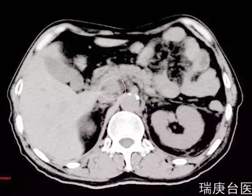 案例分享 | 食管癌腹膜后淋巴结转移 ,质子治疗肿瘤完全消失