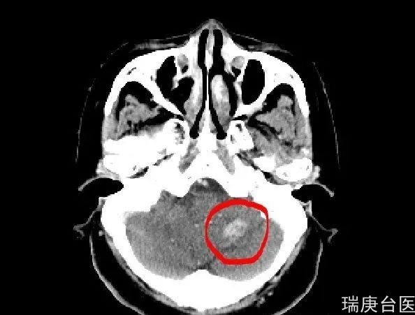 质子治疗 | 长在眼睛、脑子、脊柱等重要器官，无法手术容易复发肿瘤的新选择