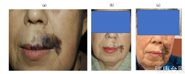 面部黑色素瘤案例 | BNCT治療后病變內黑色斑塊完全消失