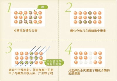 臺灣硼中子捕獲治療癌癥