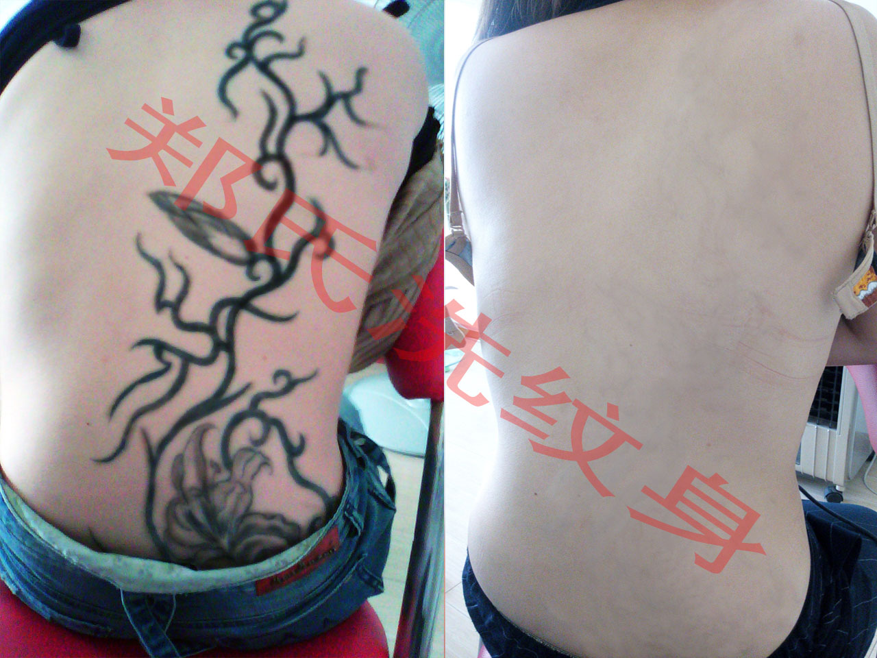 大庆洗纹身